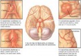 /album/fotogaleria/aneurismas-cerebrales-jpg/